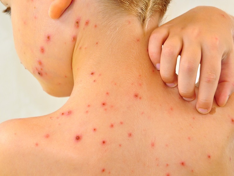 Shingles Cause and Disease