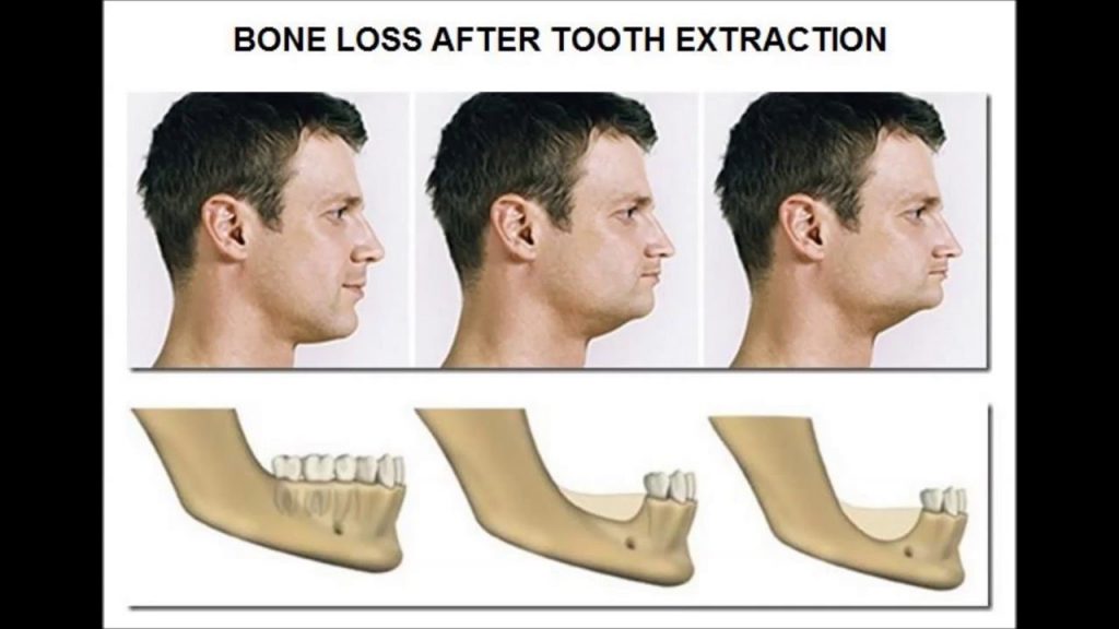 dental bone loss
