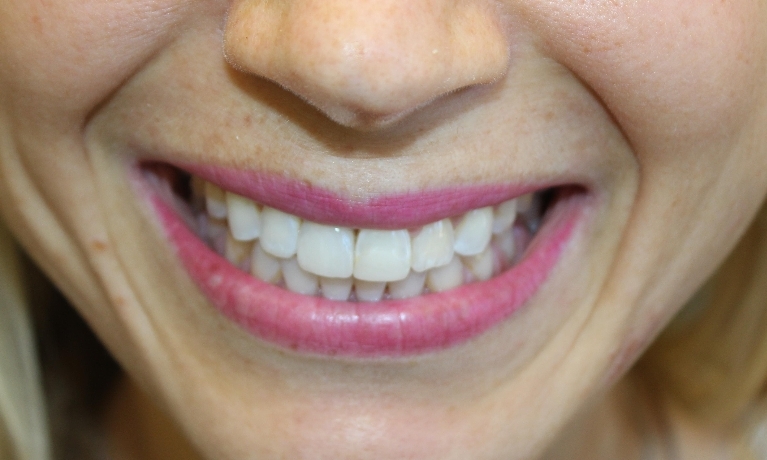 dental bone loss