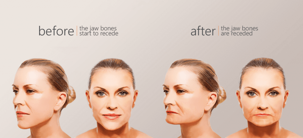 dental bone loss